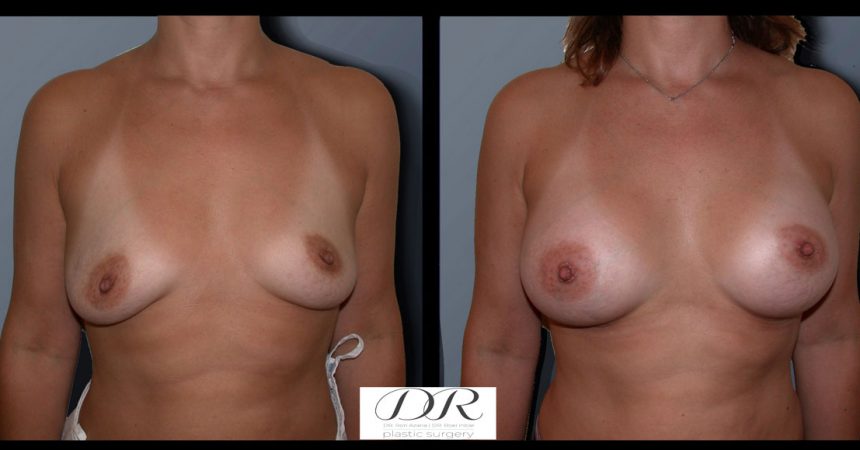 breast-asymmetry-1A