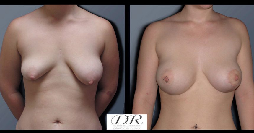 breast-asymmetry-3A