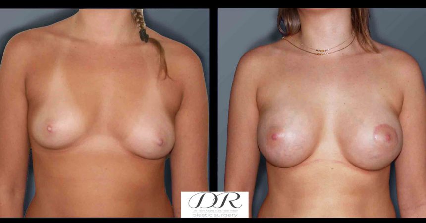 breast-asymmetry-6A
