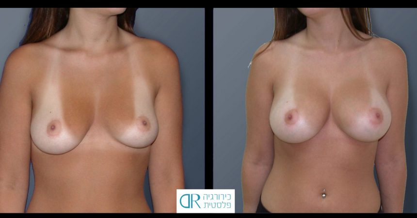 breast-asymmetry-9A