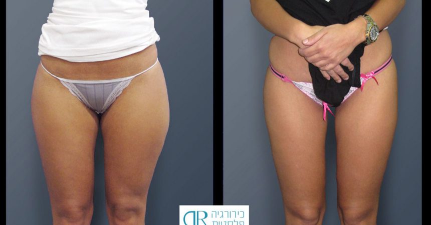 liposction-26-yo-female-thighs-1A