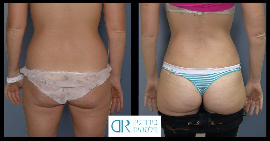liposuction-3-lipo-filling-buttock