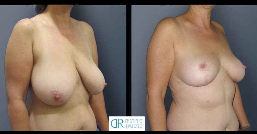 breast-reduction-10B