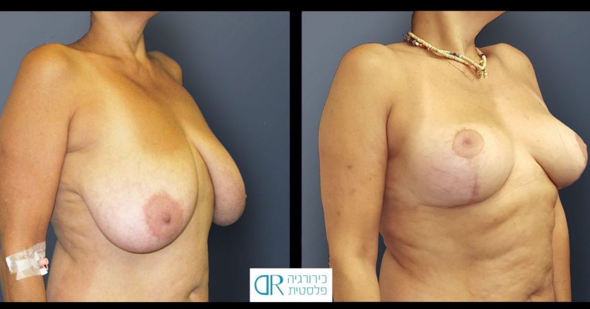 breast-reduction-11B