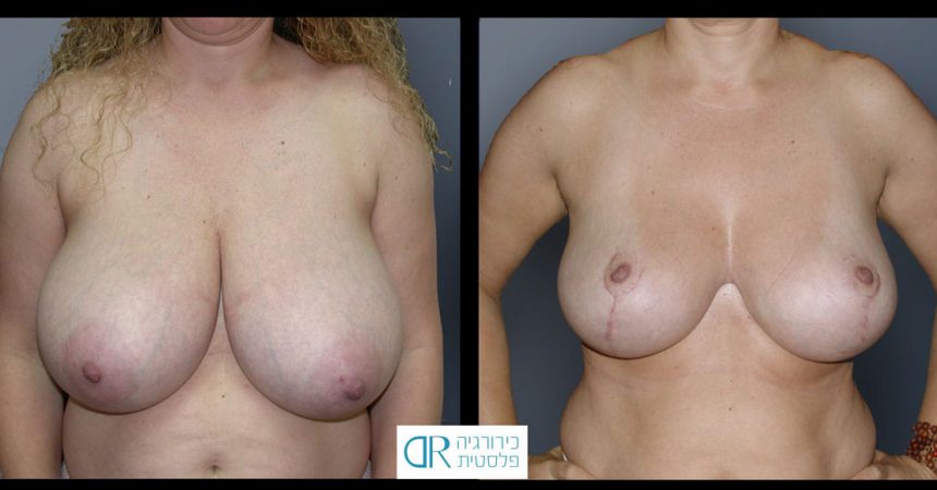 breast-reduction-12A