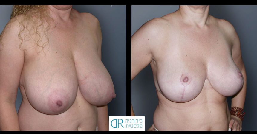 breast-reduction-12B