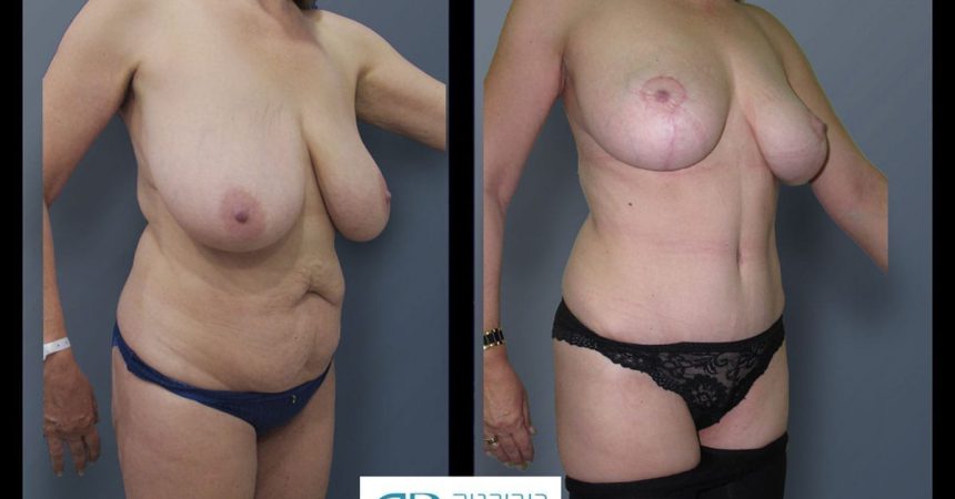 breast-reduction-and-abdomen-3B