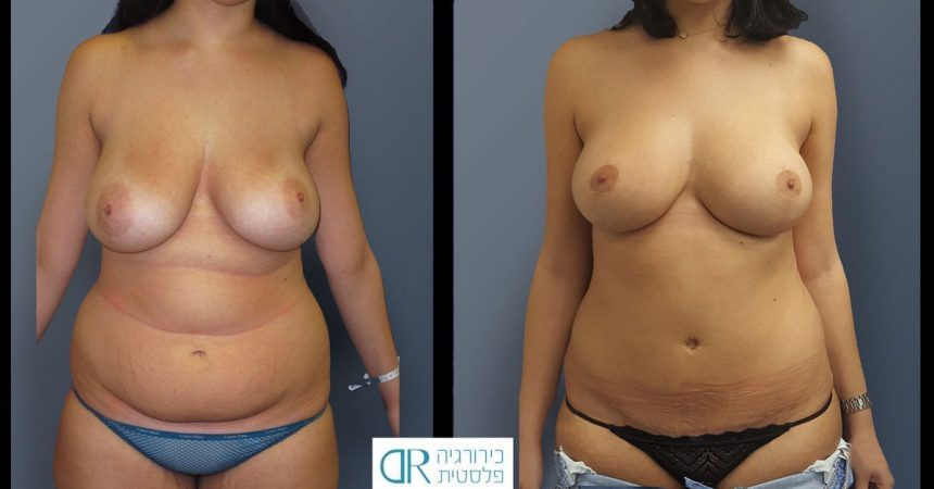 breast-pexy-abdominoplsty-2A