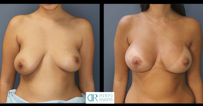 breast-asymmetry-10A