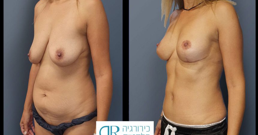 breast-pexy-abdominoplsty-11A